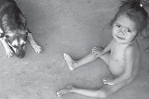 Young child suffering from malnutrition in Argentina